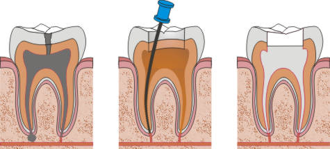 Endodoncia