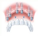 Implantes Dentales