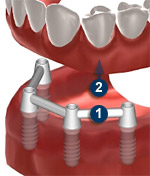 Implantes Dentales