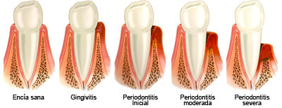 Periodoncia